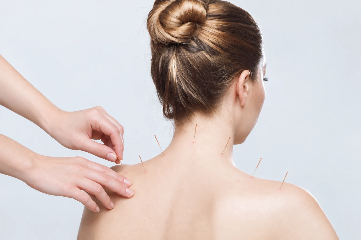 Acupuncture needles placed on the neck and shoulders